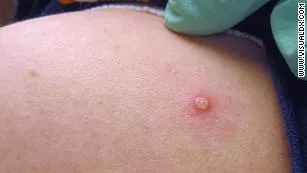 Monkeypox, the new threat